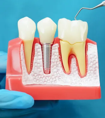 Dental Implants at Southern Prosthodontics in North, MS