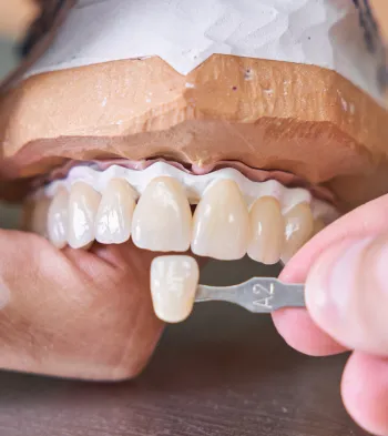 Dental Veneers at Southern Prosthodontics in North, MS