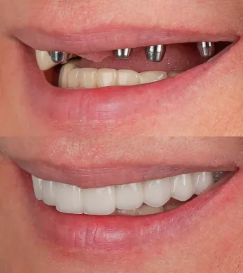 Fixed Hybrid Implants at Southern Prosthodontics in North, MS